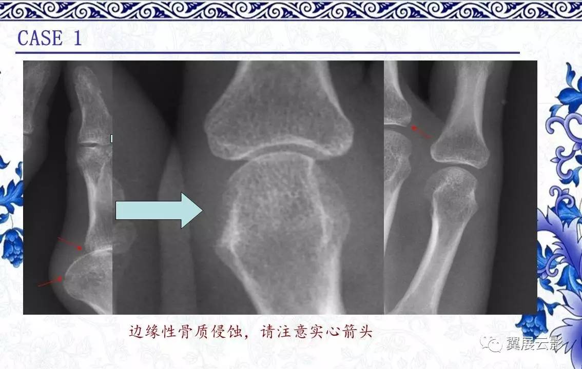 【课后发布】类风湿关节炎的x线表现