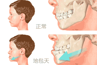 有的兜齿是可以矫正或通过整形手术修正的.