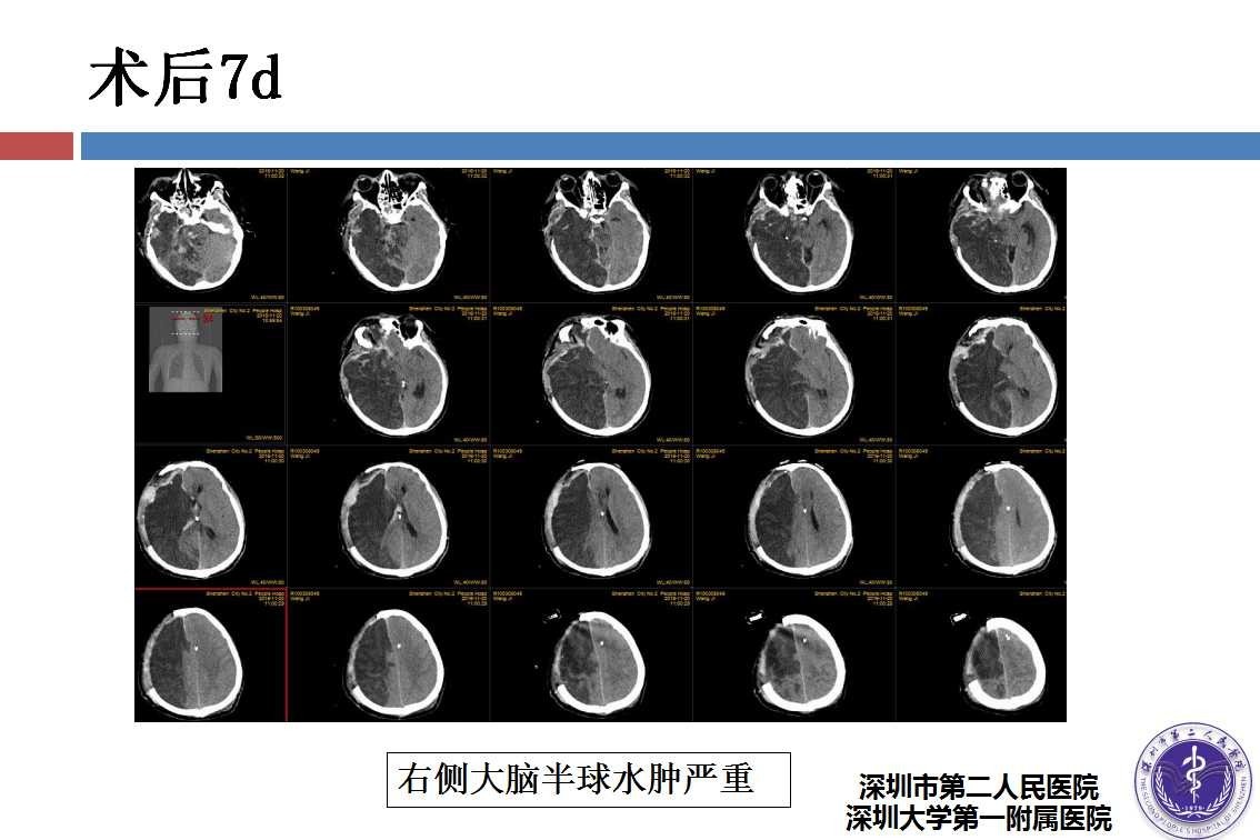 钢筋致穿透性颅脑损伤病例分享一例丨颅脑创伤神经重症病例周刊第27期