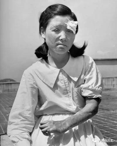 广岛原子弹爆炸受害者留下的伤疤