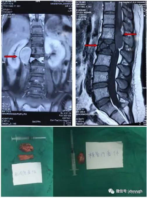脊柱外二科付长峰医疗组成功治疗一例腰椎复杂肿瘤