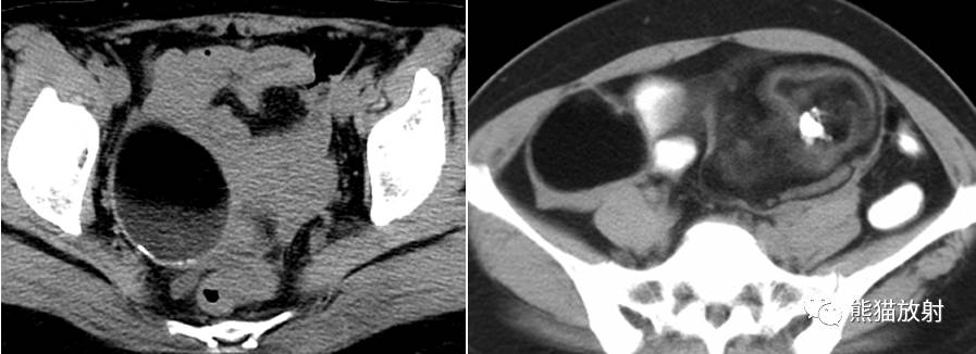 【专题】卵巢囊性病变的影像诊断及鉴别诊断(mri,ct)