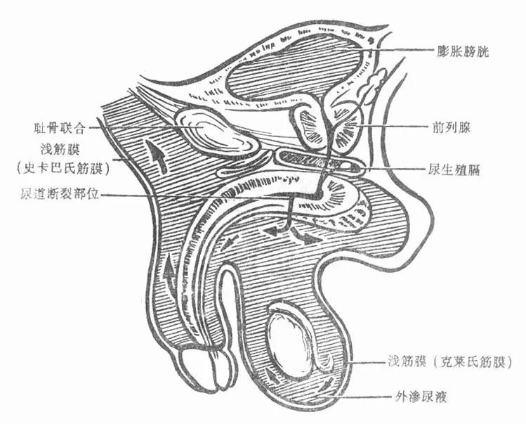 医源性因素,作为引起尿道直肠瘘的最常见原因,包括膀胱镜检,尿道扩张