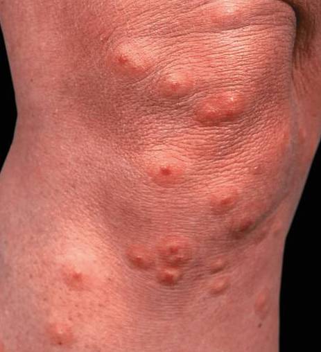 注入毒液到皮肤 皮肤就会出现点状,片状,条索状 严重的人会出现水疱