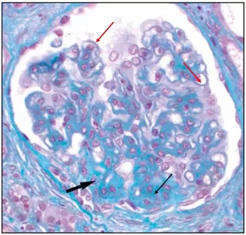 黑色箭头:肾小球系膜轻度增生光镜表现图 1 绿色:肾小球脏层上皮细胞