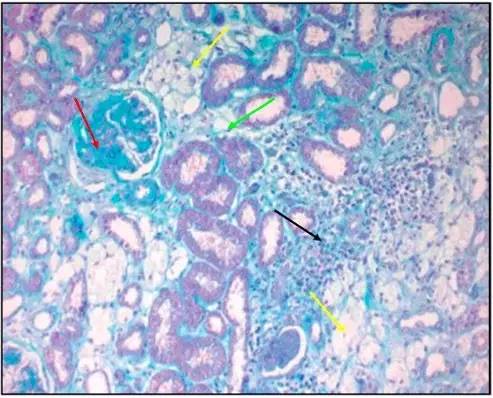 masson 染色:绿色箭头:肾小管内红细胞管型形成;红色箭头:肾小管