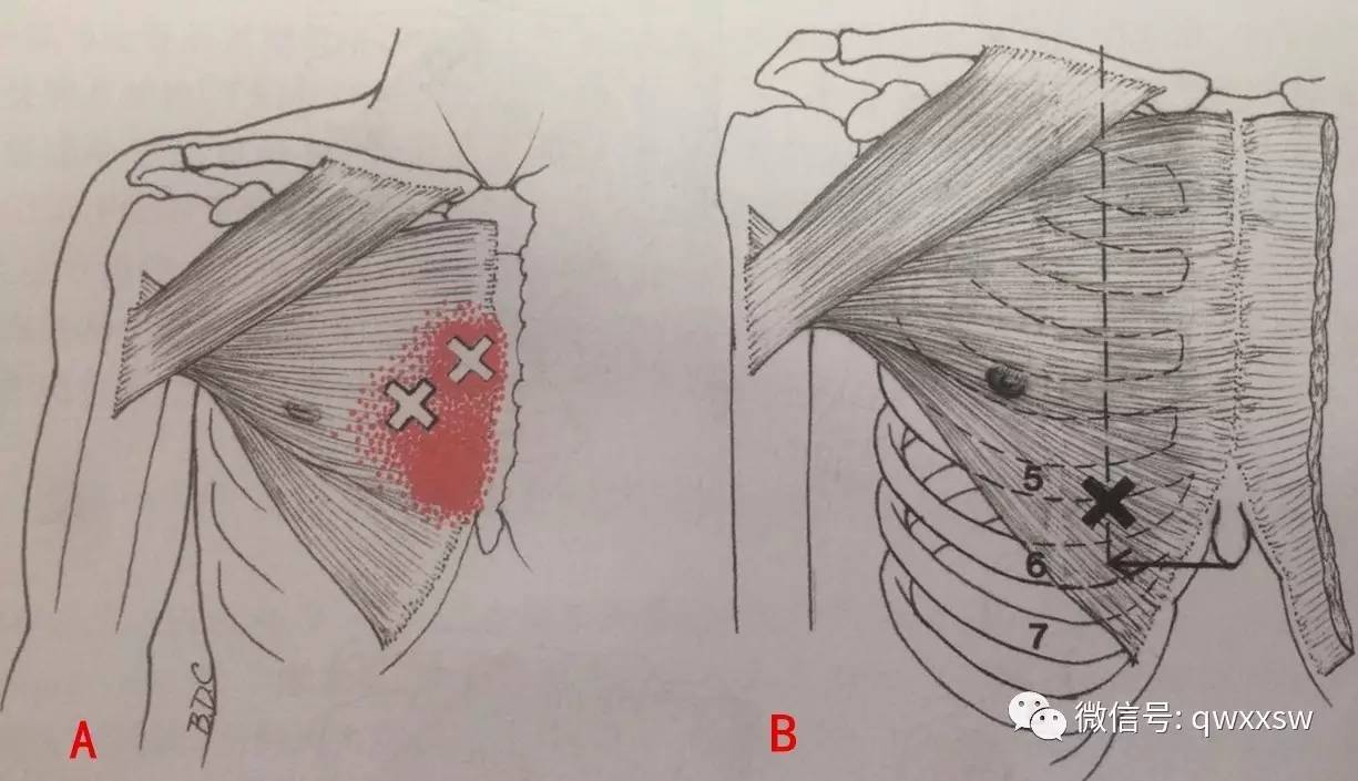 查体:焦虑面容,圆肩驼背,触诊双侧胸大肌紧张,压痛(   ),前正中线右侧