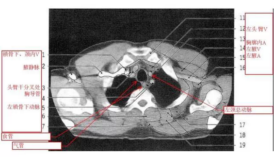 一文掌握胸部ct阅读基本功,晋级影像高手