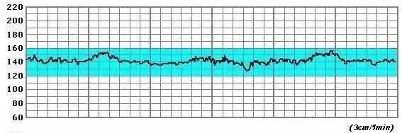 胎心监护图上会有两条曲线, 一条记录的是胎心率的变化,另外一条记录