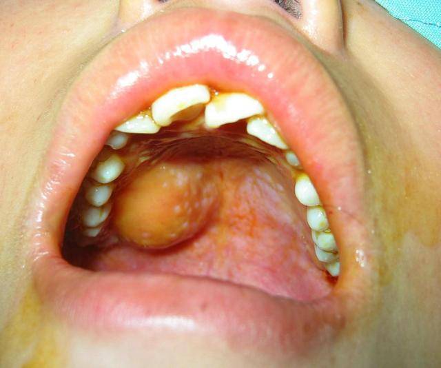 口腔长瘤子图片图片
