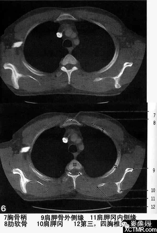 胸部骨窗ct斷層,就該這麼看!