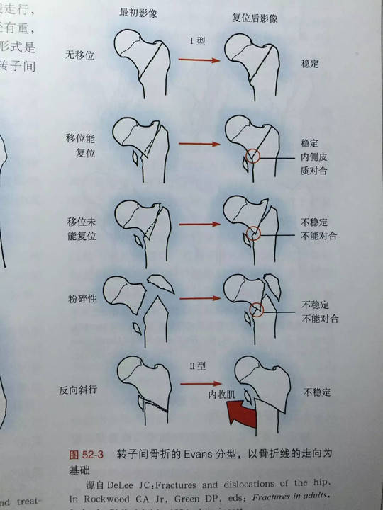 股骨转子间骨折 evans 分型到底应该怎么分