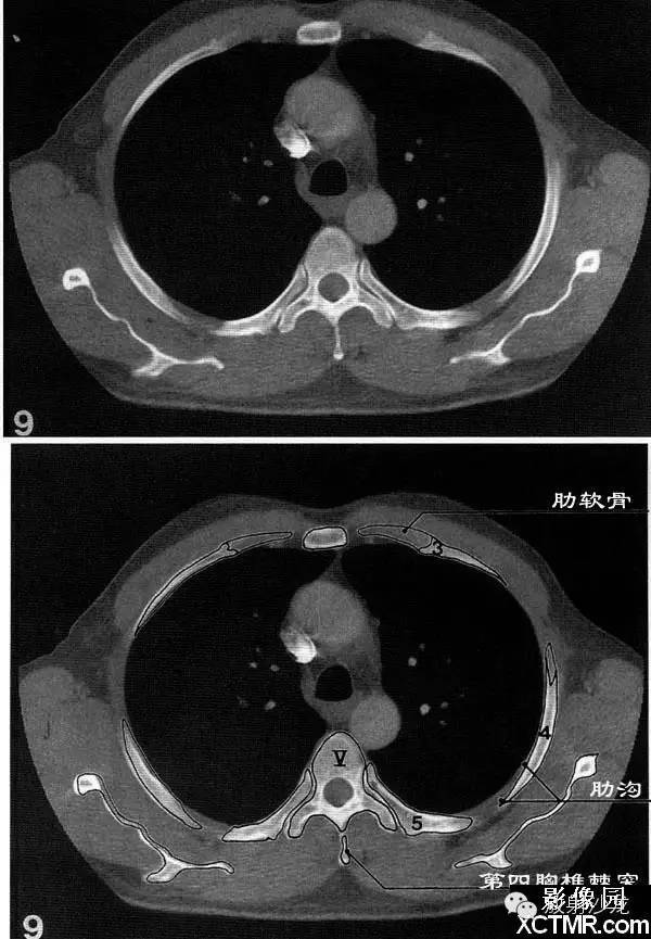 胸部骨窗ct斷層,就該這麼看!