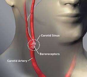 颈动脉窦位置图片