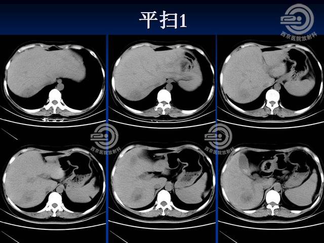 病例分享:腹部ct影像诊断分析