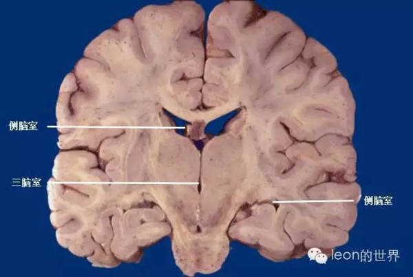 超精美!第三脑室解剖图谱