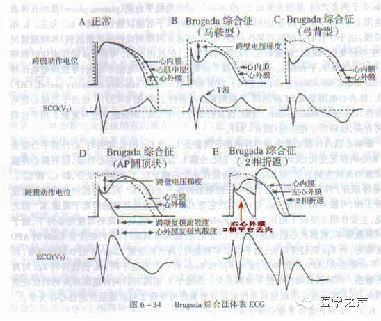 brugada波心电图意义图片