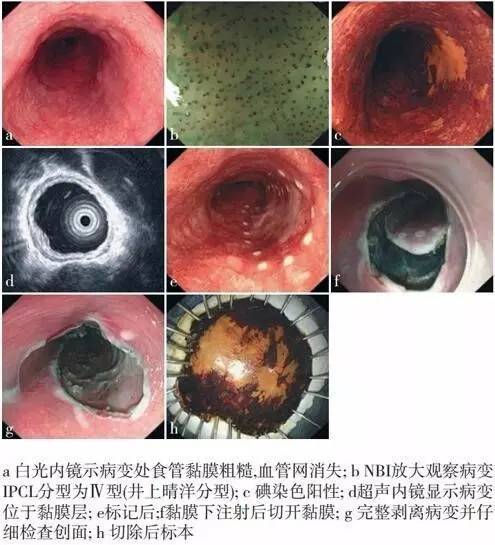 全面解析早期食管癌的内镜诊疗,你想知道的都在这里了!