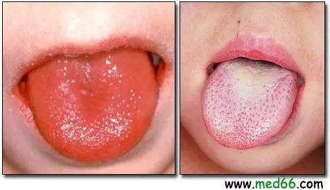 有些家长会发现,自己孩子的舌头有很多白点点或红点点,就像草莓的表皮