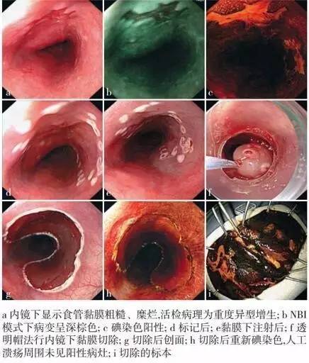 全面解析早期食管癌的内镜诊疗,你想知道的都在这里了!