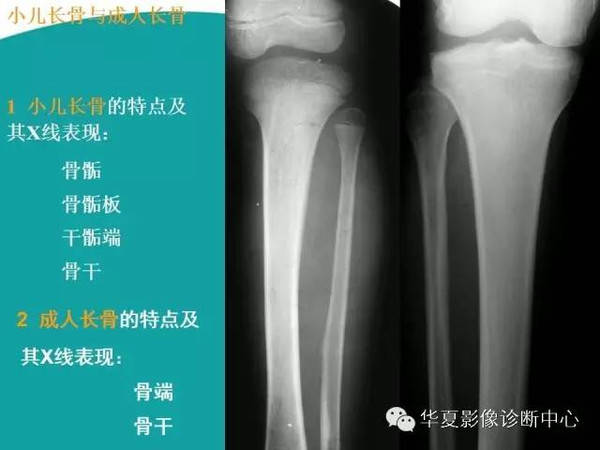 双骨单骨的区别图片图片