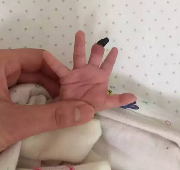23天的宝宝手指变黑截肢,只因妈妈给她戴了这个!很多慈溪宝宝也会带
