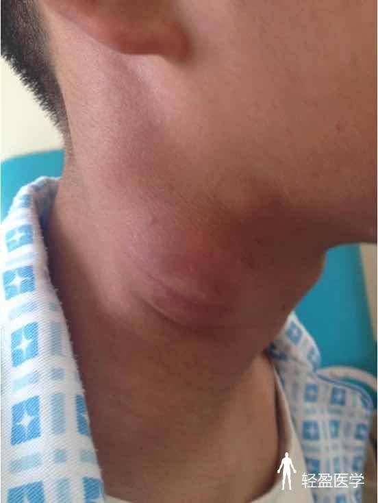 13岁男孩,发现右颈部包块,诊断为淋巴结结核!
