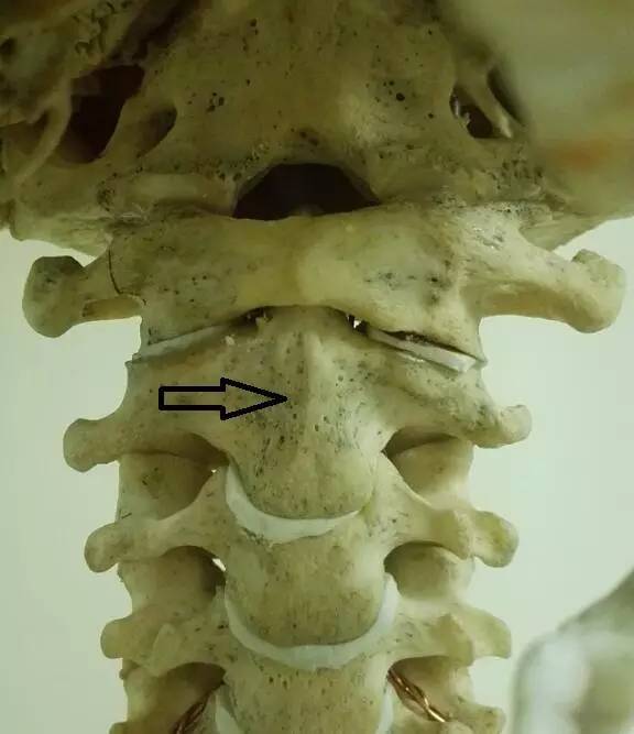 枢椎 齿状突图片