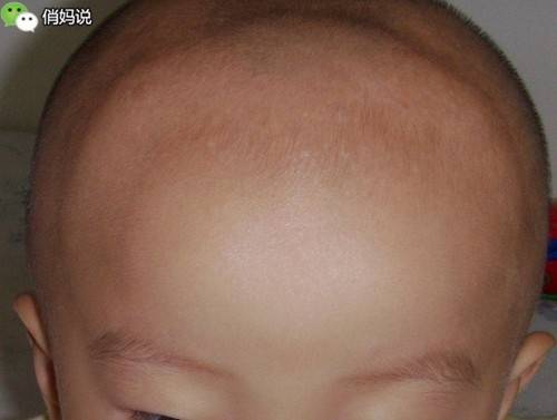 宝宝缺钙的头部照片图片