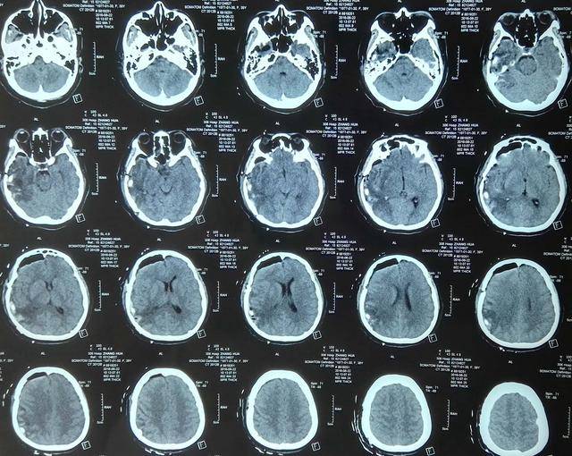 脑CT能查出肿瘤吗？