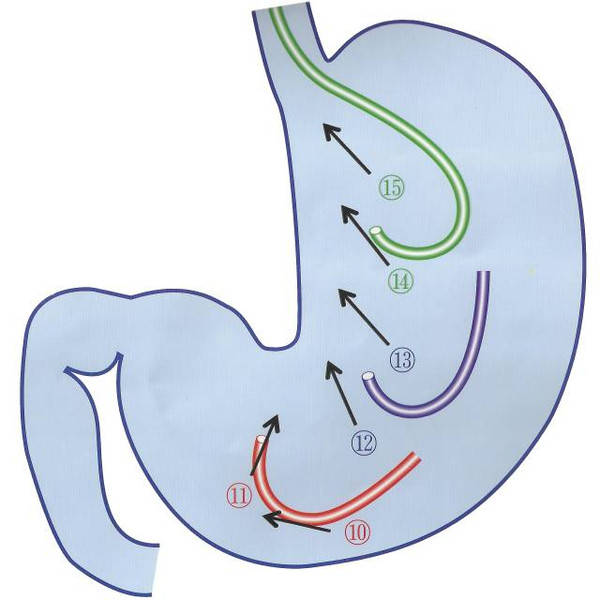 退镜到胃部,通过j弯的方式观察胃角部,胃体部,贲门部,保持内镜j弯旋转