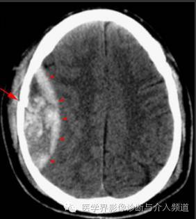 (左图示左侧硬膜下新月形低密度影,系血肿吸收期改变;右图示右侧慢性