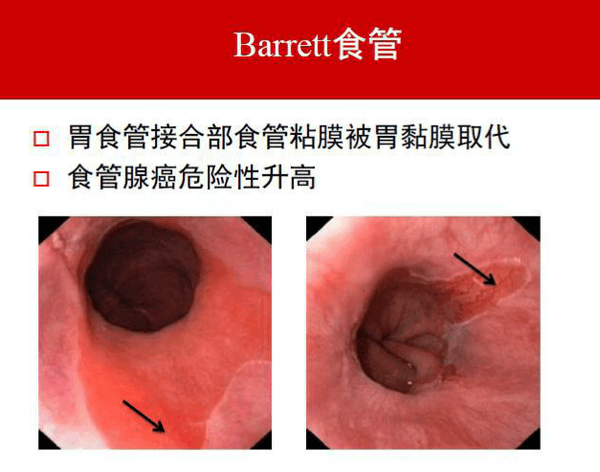 巴雷特食管舌形图片