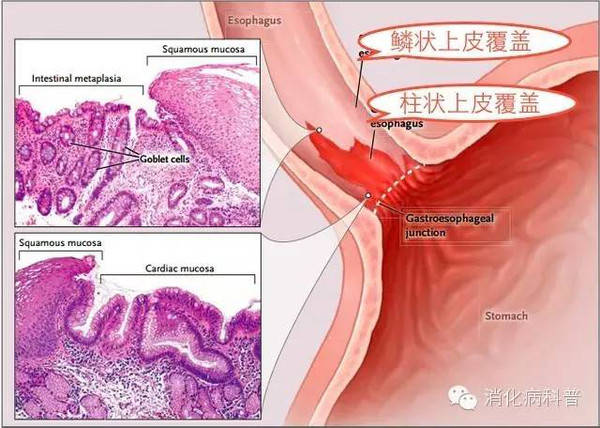 中国巴雷特食管癌变率图片