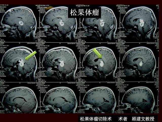 罕見腦內巨大松果體瘤切除術