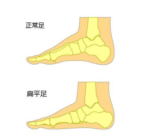 扁平足示意图图片