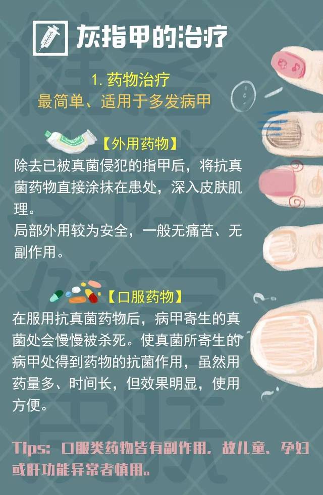 得了灰指甲怎么办?