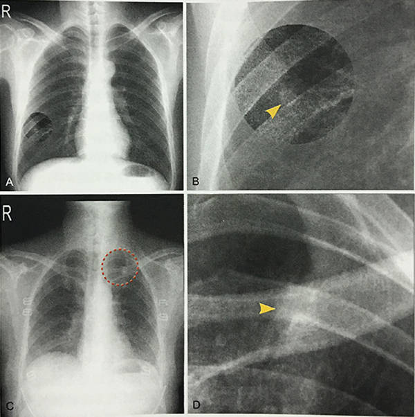 肺癌胸片图图片
