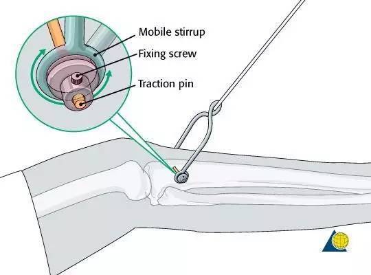 胫骨结节骨牵引术步骤图片