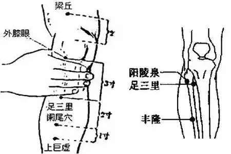 艾灸治疗慢性阑尾炎