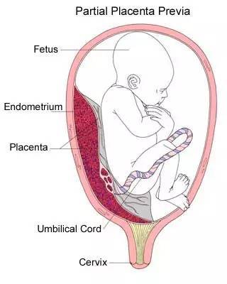 第一产程末,宫口扩张至8～9cm,宫腔内压力明显增强,且超过胎膜张力时