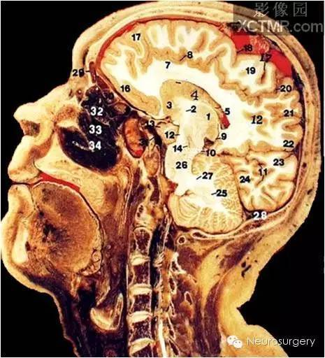 经典颅脑断层解剖图——矢状位