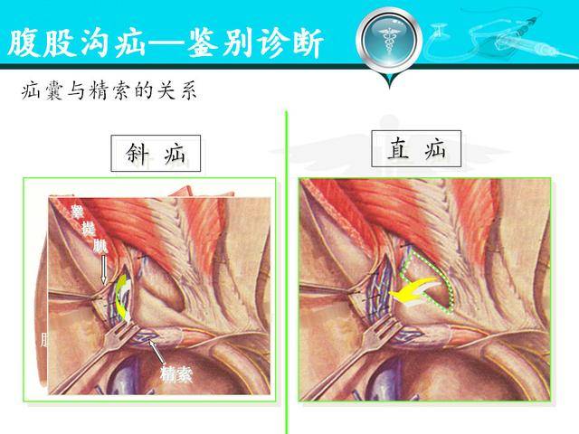 斜疝解剖图图片