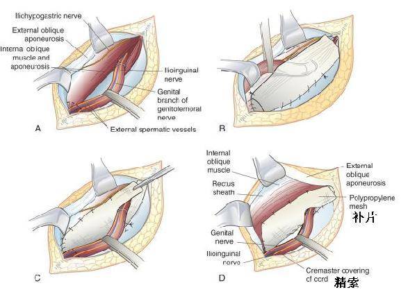 iii:斜疝,內環口大於二指(>4cm),腹橫筋膜和腹股溝管後壁不完整或