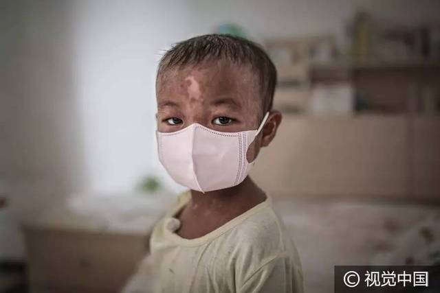 来自安徽歙县的4岁儿童钱彩琳,出生后20天被确诊为白血病