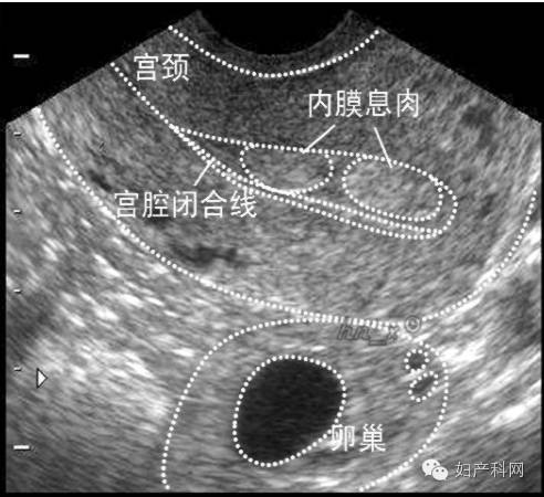 子宮內膜息肉超聲診斷大全