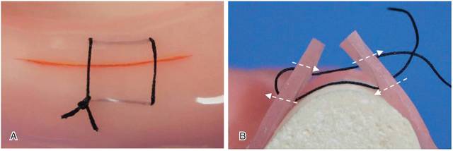 ①水平褥式缝合(图6a)用于牙龈瓣幅度宽的手术部位