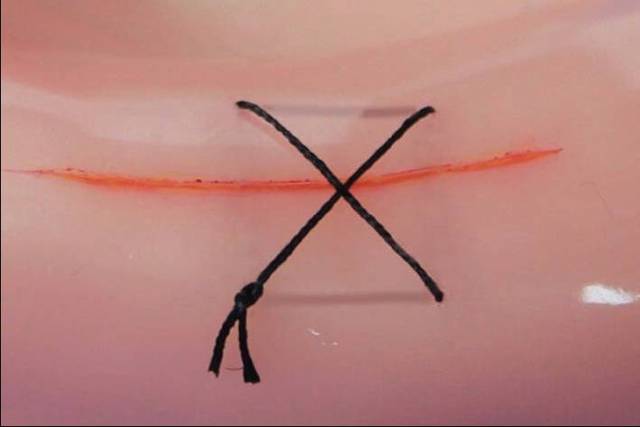 ①水平褥式缝合(图6a)用于牙龈瓣幅度宽的手术部位