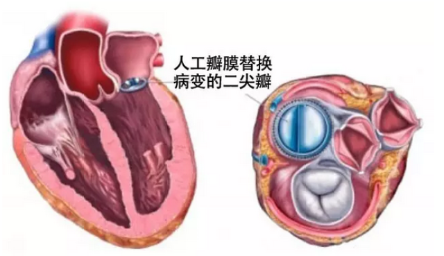 台湾永信:心脏阀门出故障了怎么办?