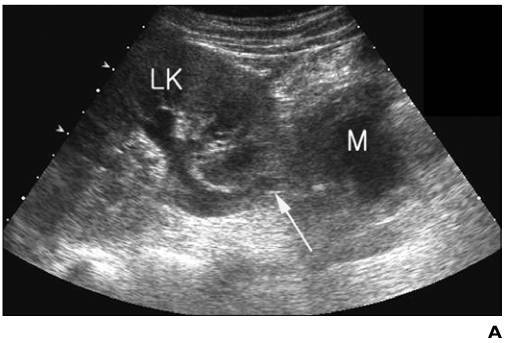 包块压迫左侧 输尿管导致左肾盂输尿管近端轻度扩张